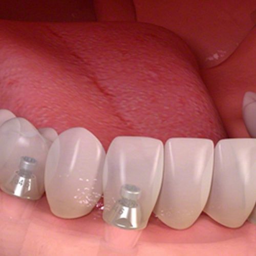 Implantes dentales