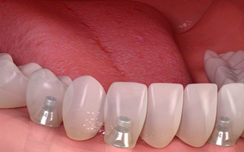 Implantes dentales