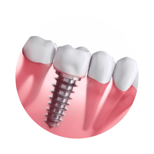 Implantes dentales Soludent