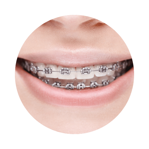 Ortodoncia convencional Soludent