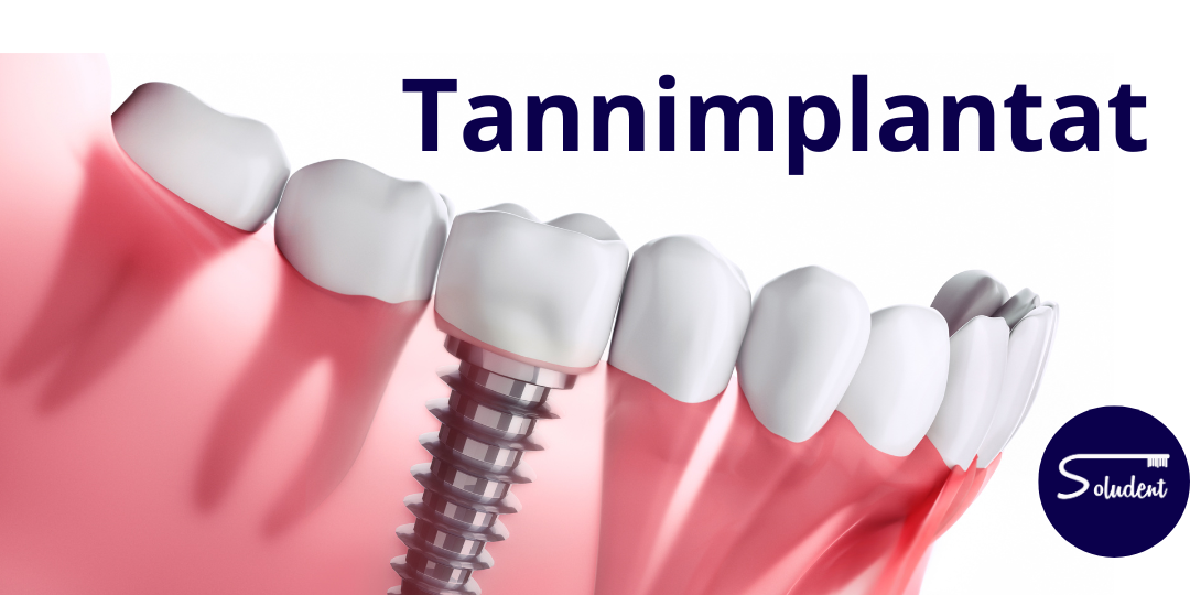 Tannnimplantater