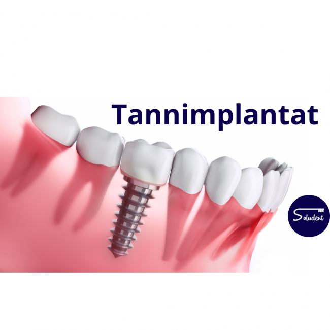 Tannnimplantater