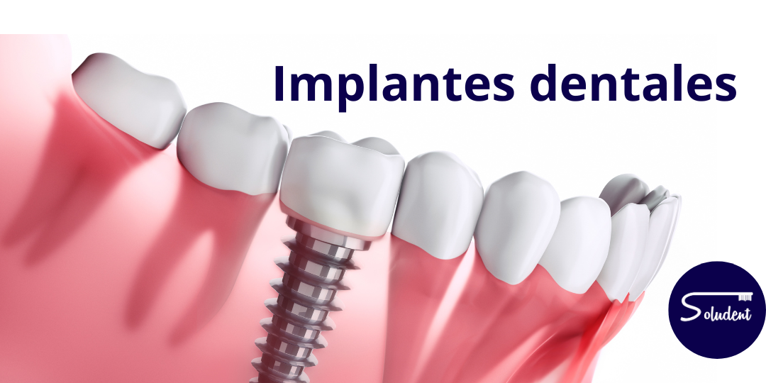 implantes dentales