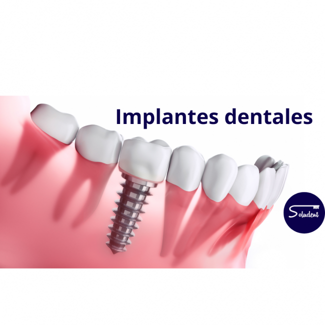 implantes dentales