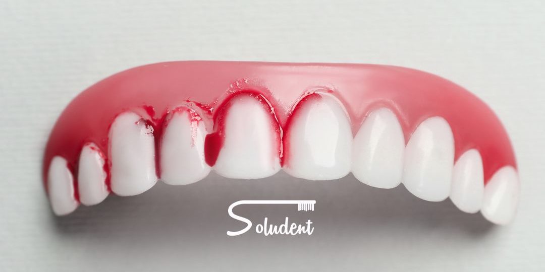 altea gingivitis
