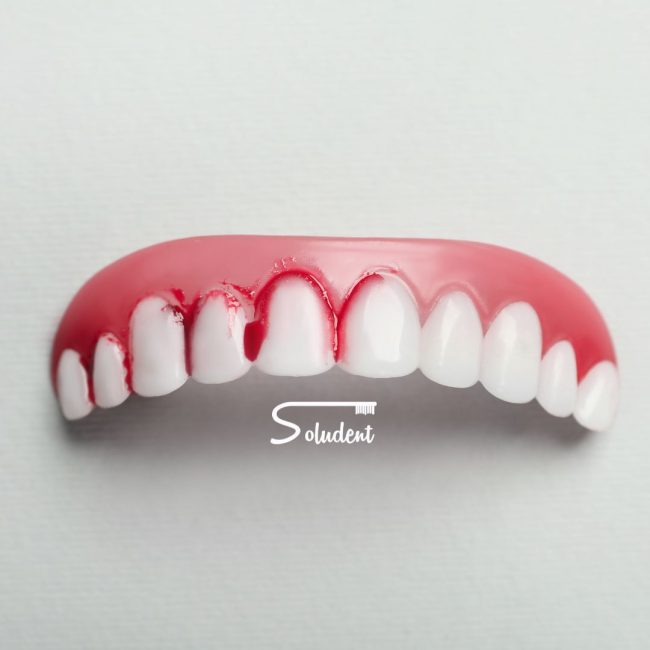altea gingivitis