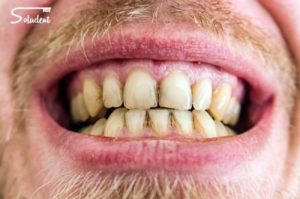 Manchas en los dientes