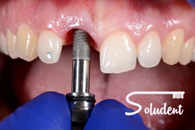 implantes dentales