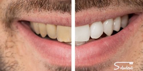 Manchas en los dientes