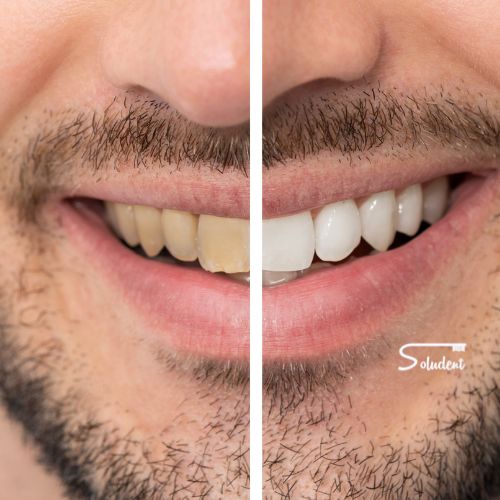 Manchas en los dientes