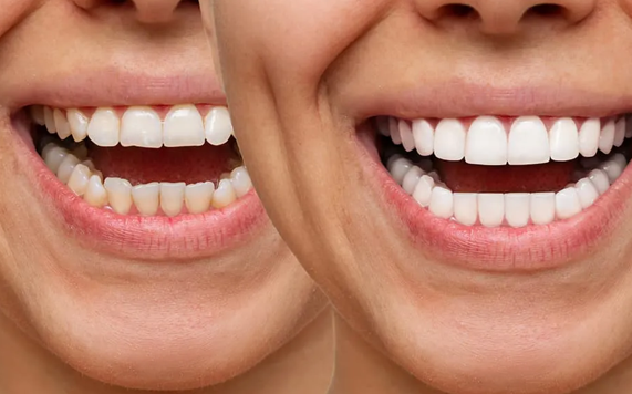 Carillas dentales