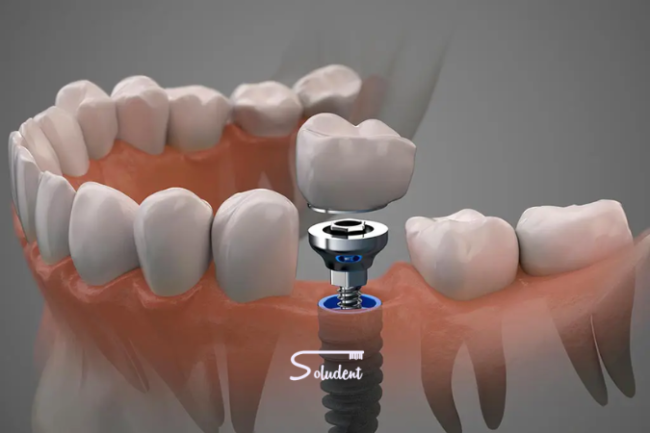 Implantes dentales cementados o atornillados