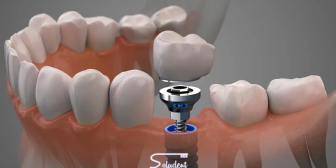Implantes dentales cementados o atornillados