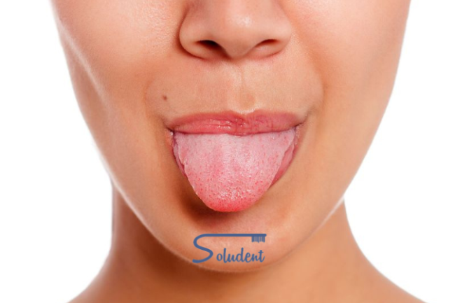 Lengua partida o agrietada