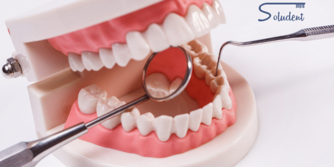 erosión dental en clínica dental soludent
