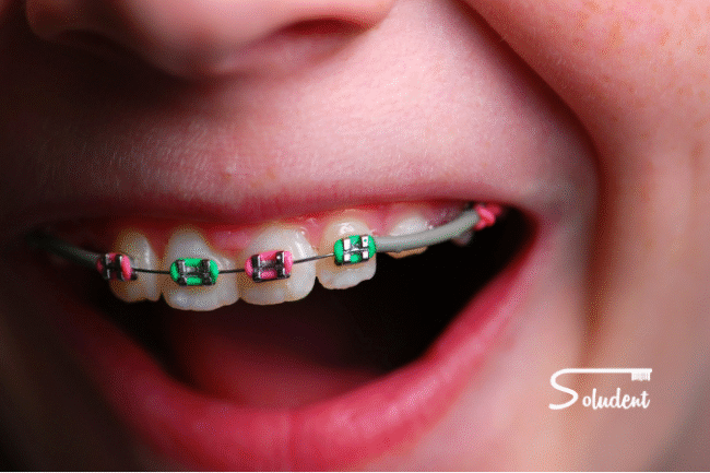 ortodoncia infantil en clínica dental soludent