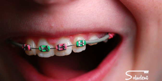 ortodoncia infantil en clínica dental soludent