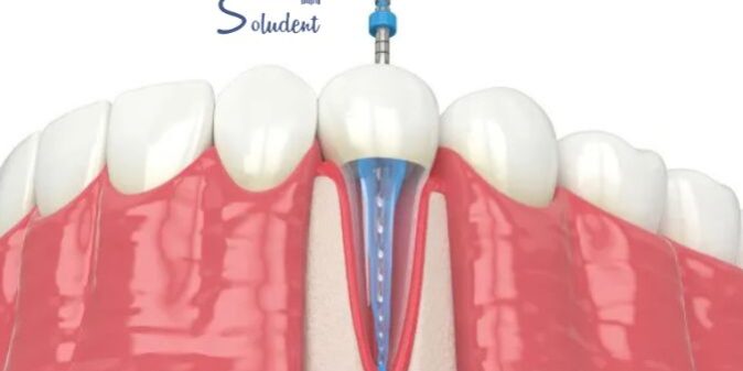 endodoncia clínica dental soludent
