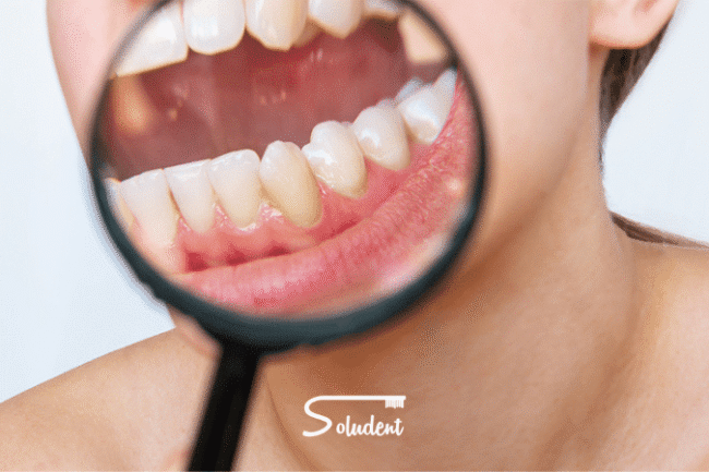 eliminar sarro en soludent
