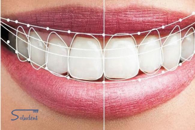 estética dental en Alfaz del Pi