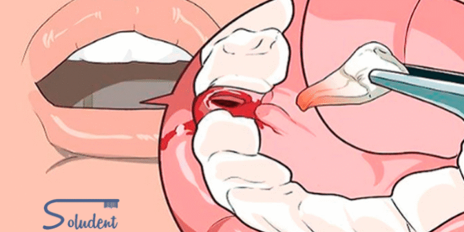 alveolitis