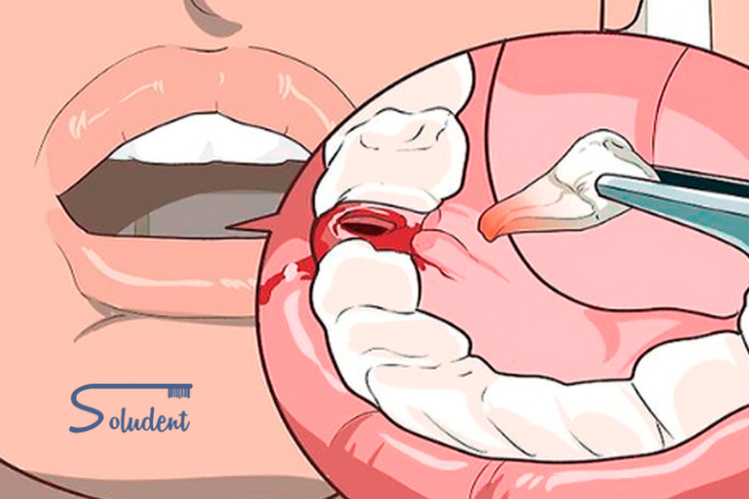 alveolitis