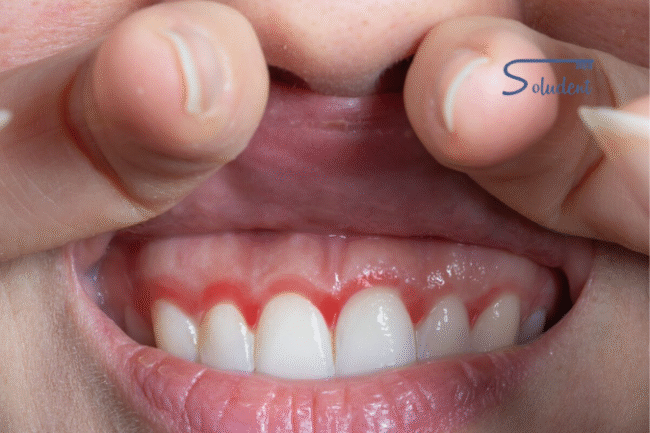 periodontitis