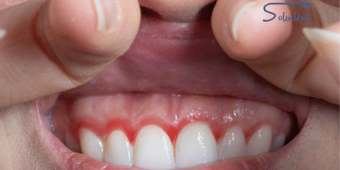 periodontitis