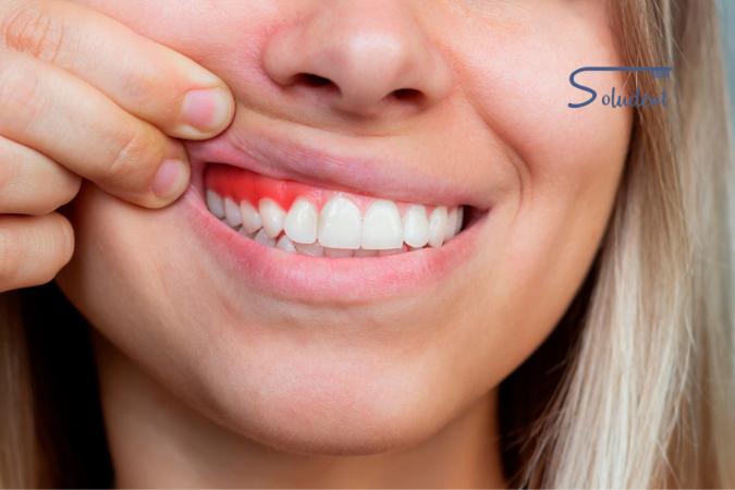 periodontitis