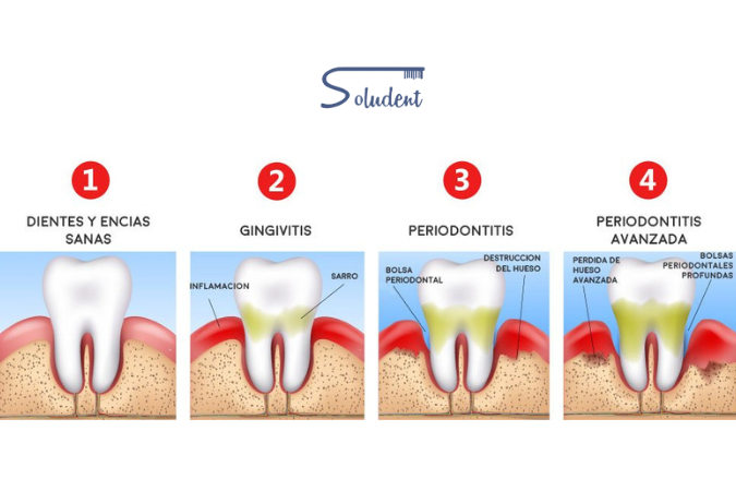 periodontitis alfaz del pi