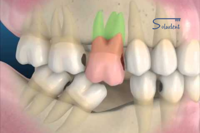 muchos años sin dientes