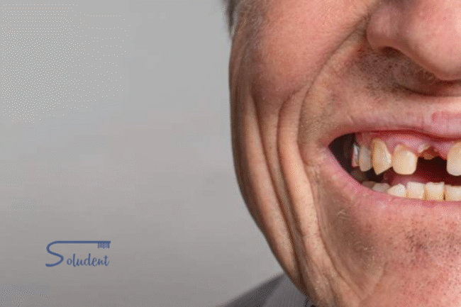 Qué ocurre cuando llevas muchos años sin dientes