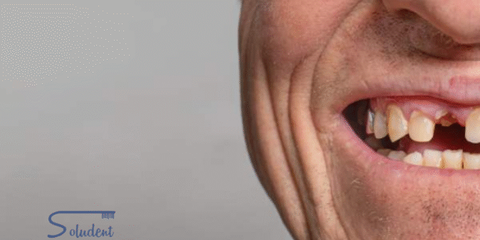Qué ocurre cuando llevas muchos años sin dientes