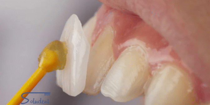 tratamiento de carillas dentales
