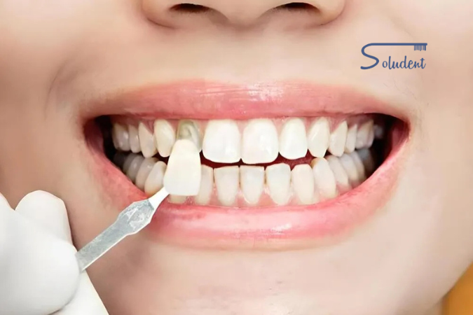 tratamiento de carillas dentales
