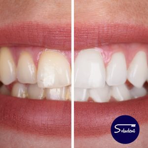 dientes mas blancos