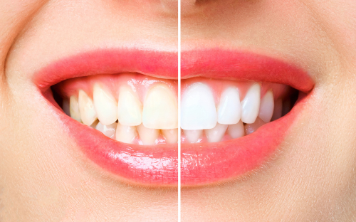blanqueamiento dental