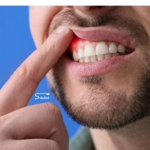 Soluciones efectiva para la gingivitis