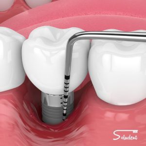 periodoncia en alfaz del pi