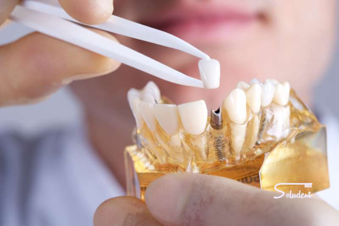 implantes dentales cementados o atornillados
