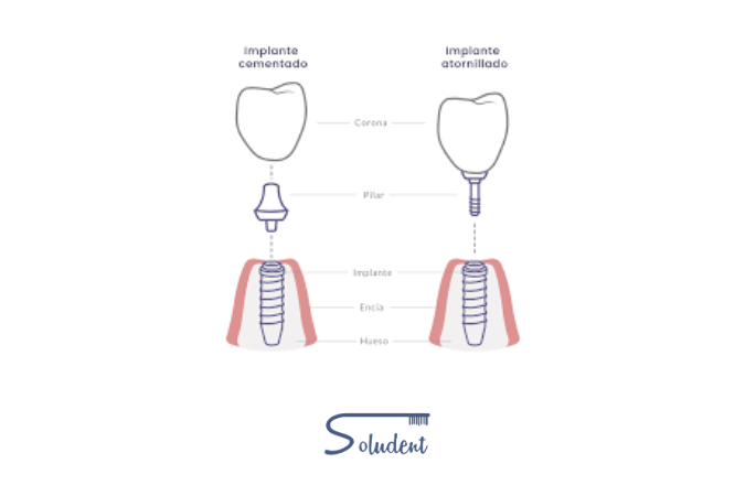 implantes dentales cementados y atornillados