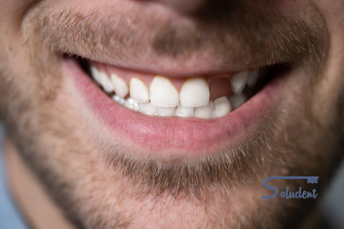 Falta de dientes
