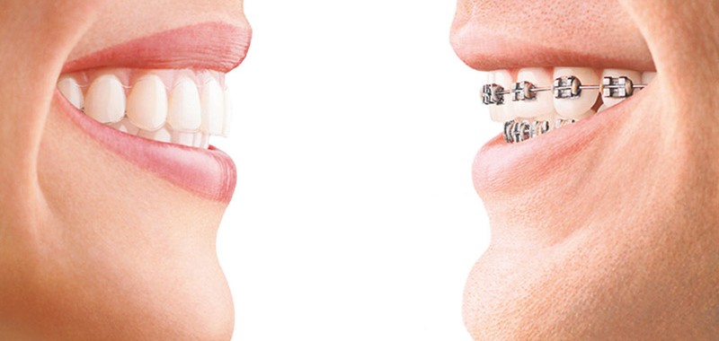 ortodoncia invisible y metálica en Clínica Dental Soludent