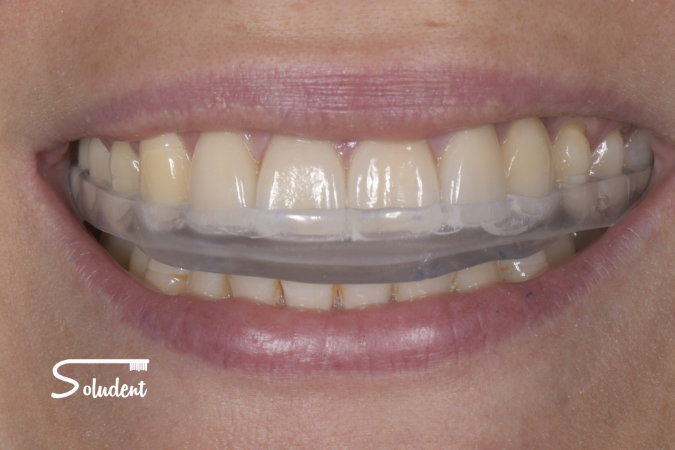 férula de descargar con clínica soludent
