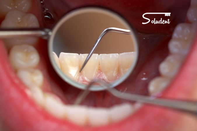 erosión dental en clínica soludent