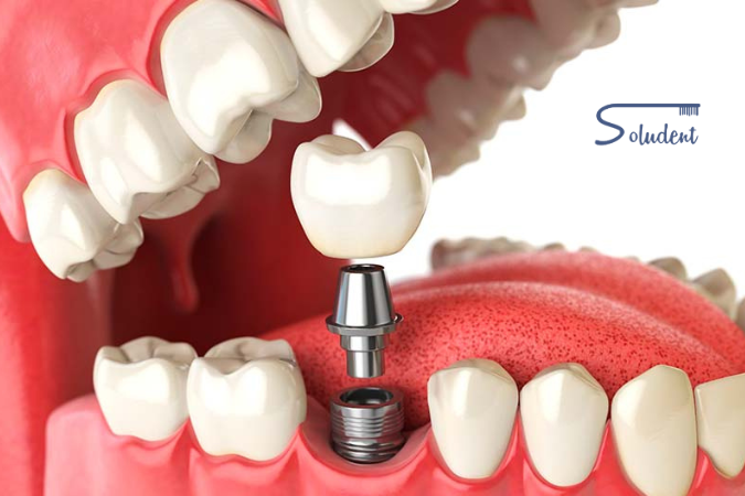 prótesis dentales en clínica dental soludent
