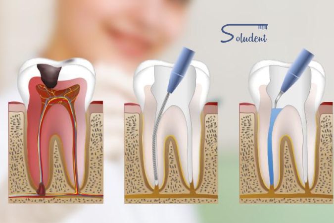 curar caries en soludent
