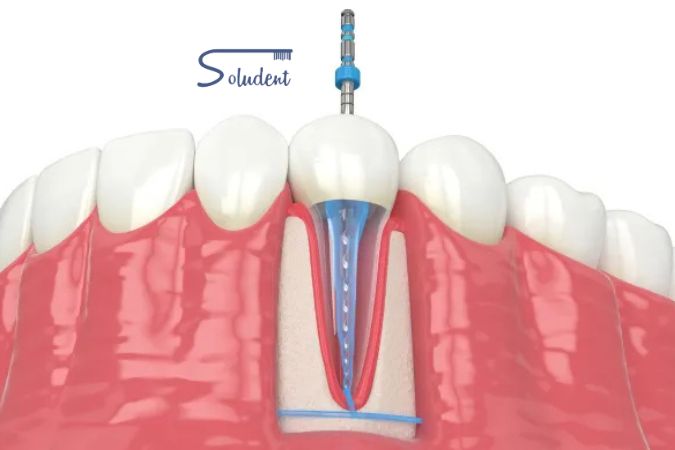 endodoncia clínica dental soludent