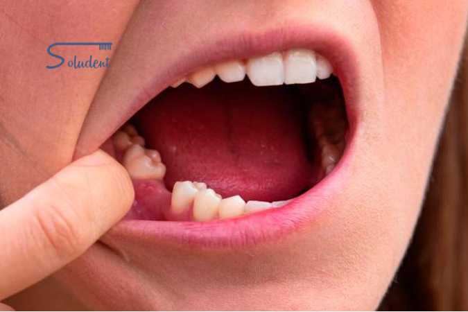 piezas dentales en soludent