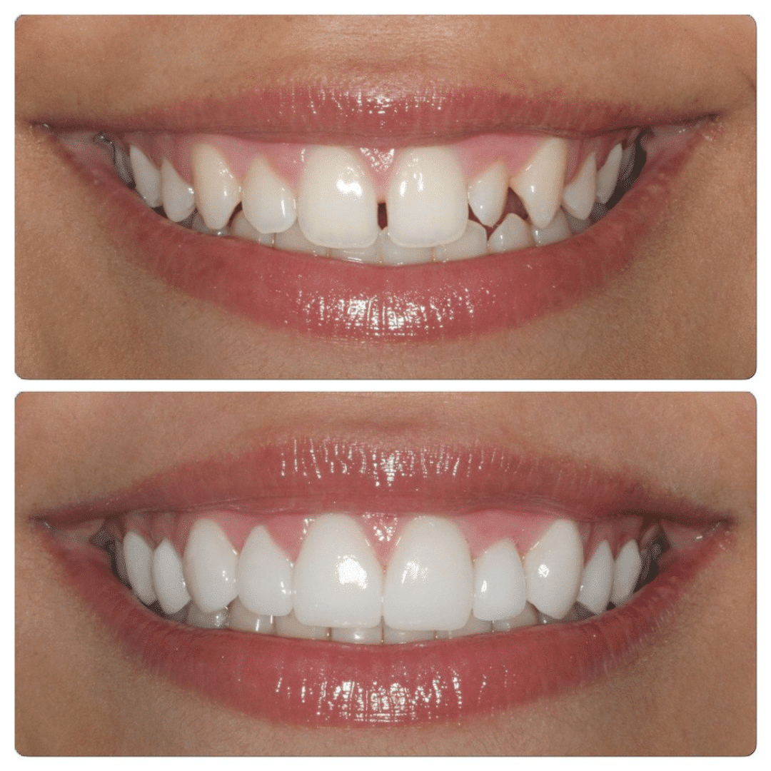 hueco-entre-dientes-soludent hueco entre los dientes soludent